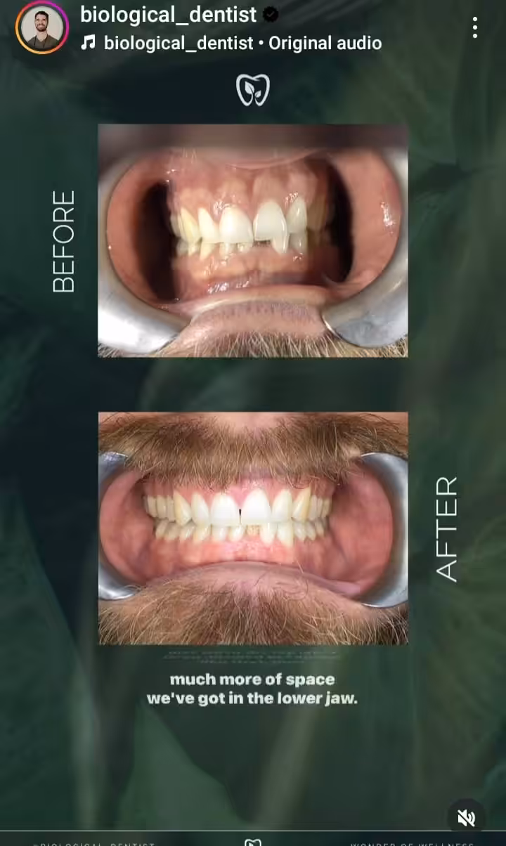 The Ultimate Guide to Social Media Marketing for Dentists in 2026 13 Snapshot of an Instagram story by biological_dentist where he has shared before and after pictures of his treatment